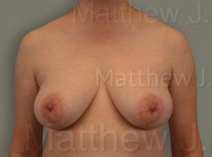 Fat Transfer to Breast