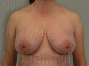 Fat Transfer to Breast