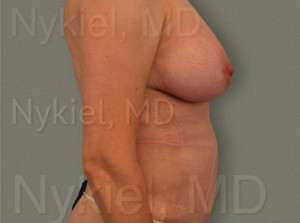 Fat Transfer to Breast