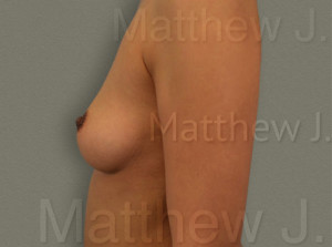 Fat Transfer to Breast