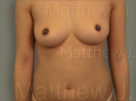 Fat Transfer to Breast