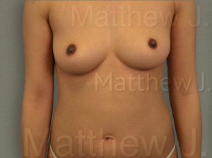 Fat Transfer to Breast