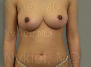 Fat Transfer to Breast