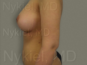 Fat Transfer to Breast